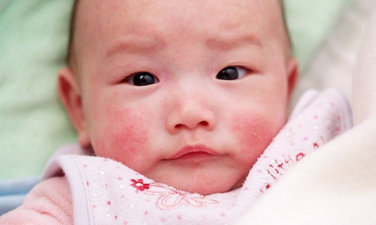 Dị ứng da ở trẻ em có nguy hiểm không? 1
