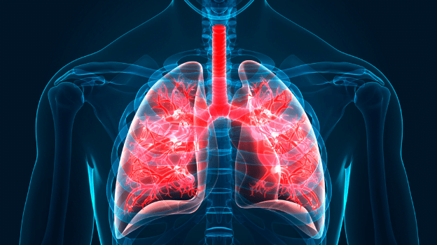 Bệnh xơ phổi có lây không? Nguyên nhân gây xơ phổi là gì? `