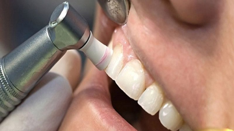 Đánh bóng răng có hại không? Lưu ý gì khi đánh bóng răng 1