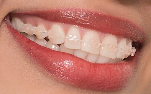 Những chia sẻ về phương pháp niềng răng mắc cài trong suốt mà bạn cần quan tâm 1