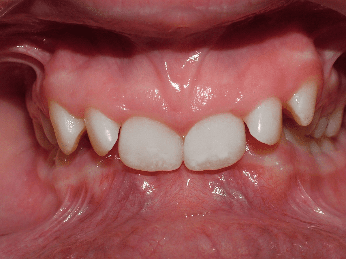 Quy trình niềng răng khớp cắn sâu gồm mấy bước?1