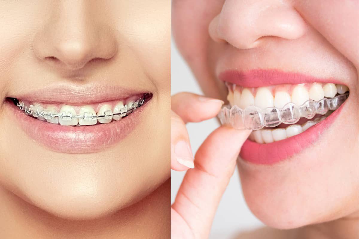 19 tuổi niềng răng bao lâu là có thể tháo mắc cài? Làm sao để rút ngắn thời gian niềng răng?