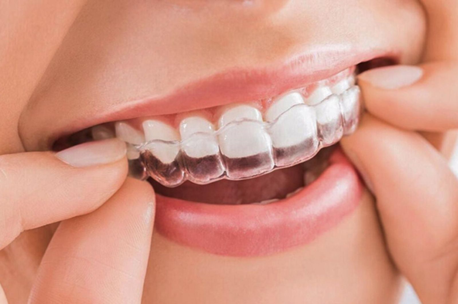 Niềng răng là phương pháp nắn chỉnh răng được áp dụng rộng rãi nhất hiện nay