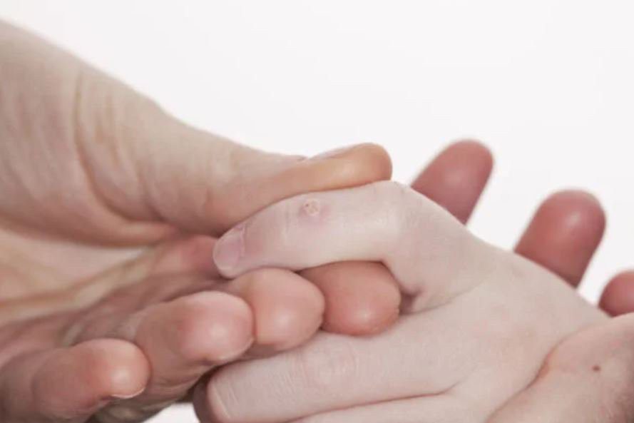 Mụn cóc là bệnh rất dễ nhận biết bởi những nốt mụn nhỏ mọc trên bề mặt da