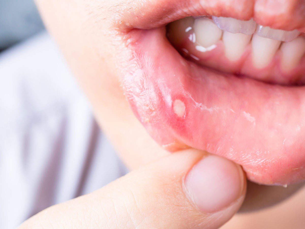 Nguyên nhân hay bị nhiệt miệng liên tục là do thiếu chất, do phản ứng phụ với các sản phẩm vệ sinh răng miệng