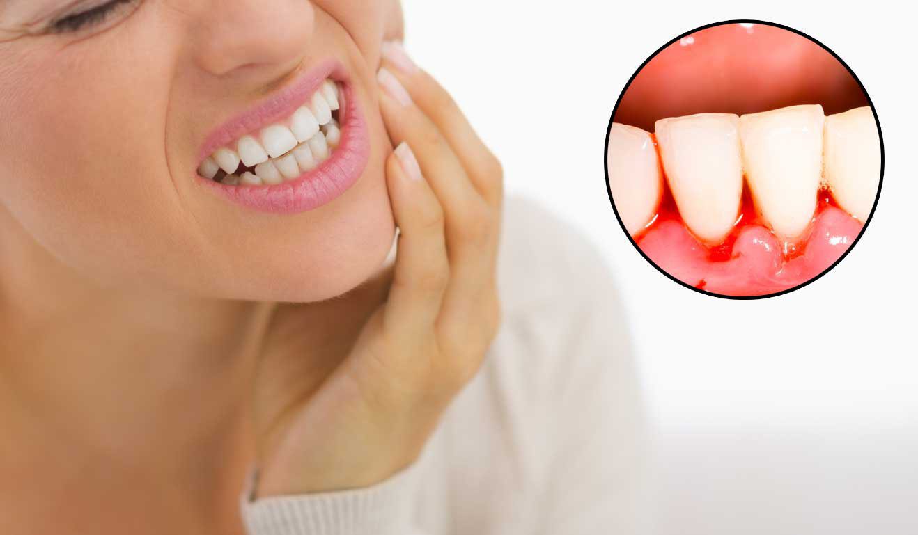 Nguyên nhân gây chảy máu chân răng khi đánh răng