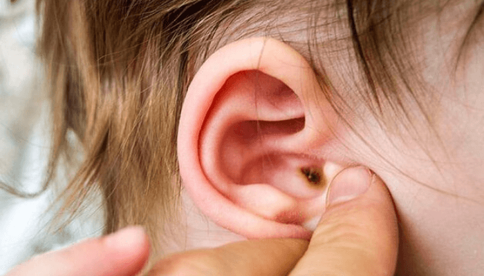 Những triệu chứng viêm tai giữa cấp cần đặc biệt chú ý 1