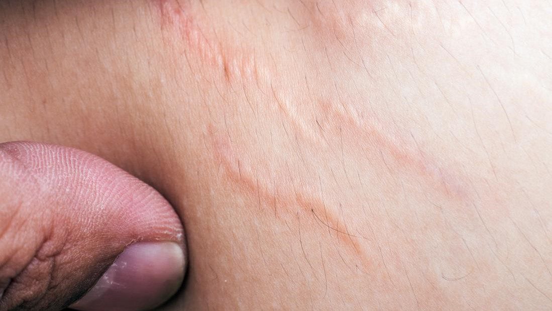 Nguyên nhân gây rạn da ở nam giới