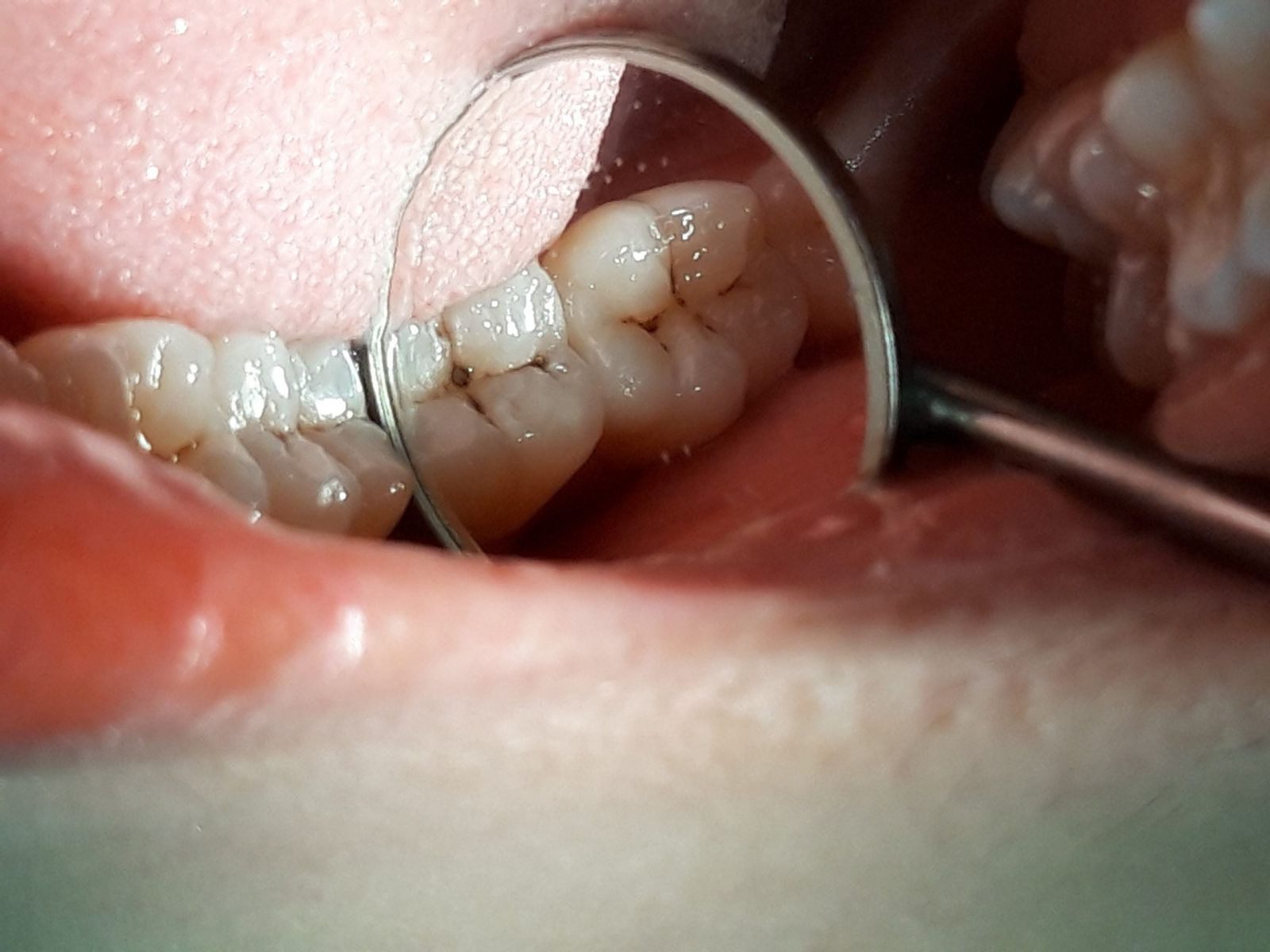 Sâu răng nhẹ cấp 1 thường bị bỏ qua