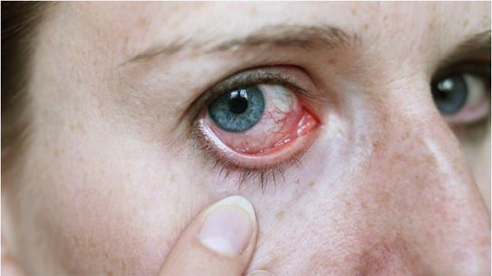 Muốn giảm chứng đau mắt đỏ sợ ánh sáng nên làm gì? 2