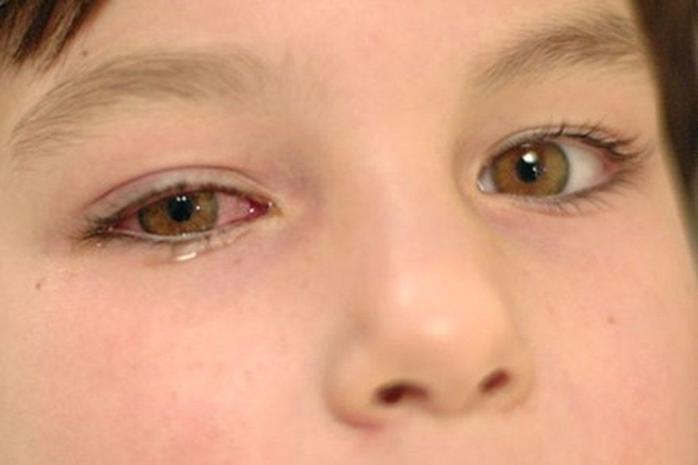Phòng bệnh đau mắt đỏ đúng và đủ cách 2