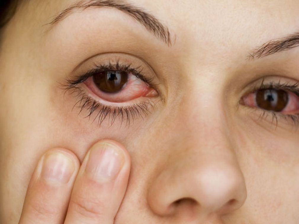 Tại sao lại có tình trạng đau mắt đỏ bị mờ mắt và cách điều trị ra sao 2
