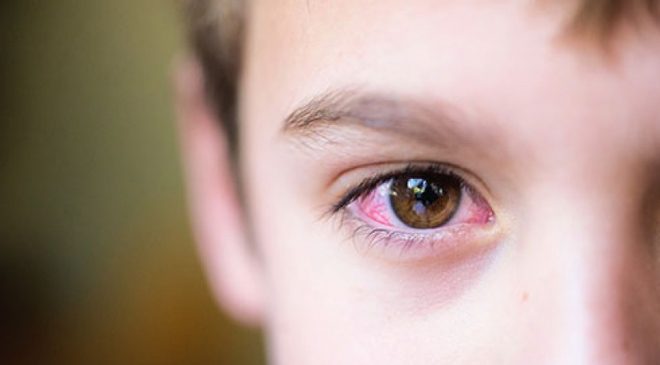 Nguyên nhân bệnh khô mắt và cách phòng ngừa2