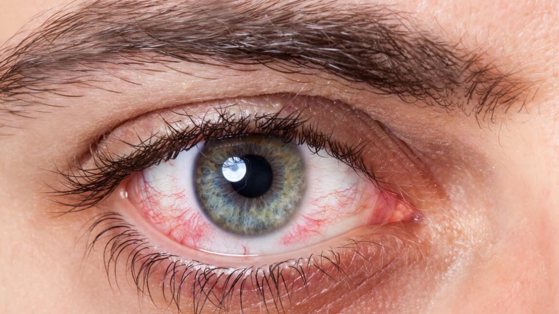 Bạn có biết nguyên nhân đau mắt đỏ và cách chữa trị như thế nào 1