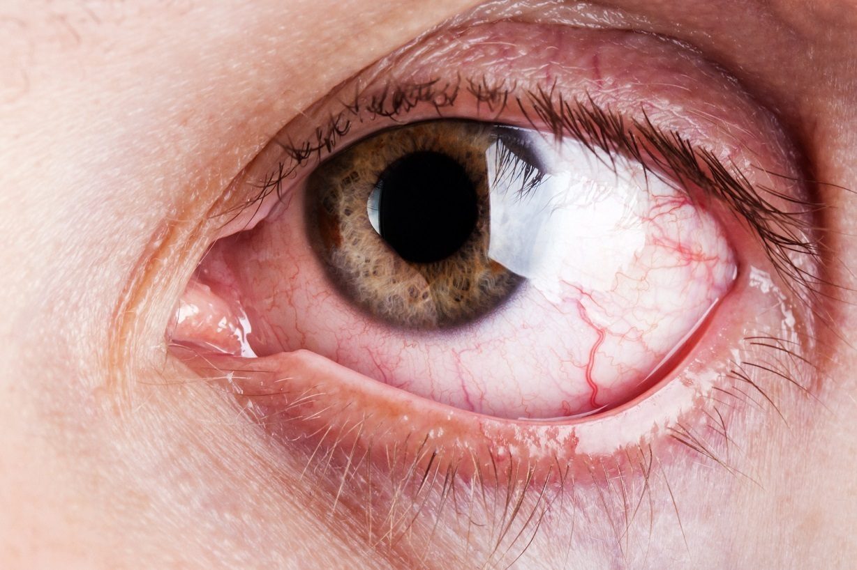 Bị đau mắt đỏ có cần uống thuốc không 1