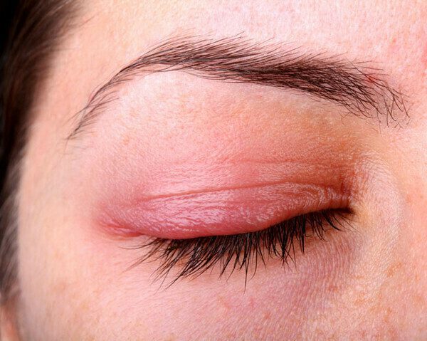 Bị đau mắt đỏ và sưng húp chữa như thế nào? 1