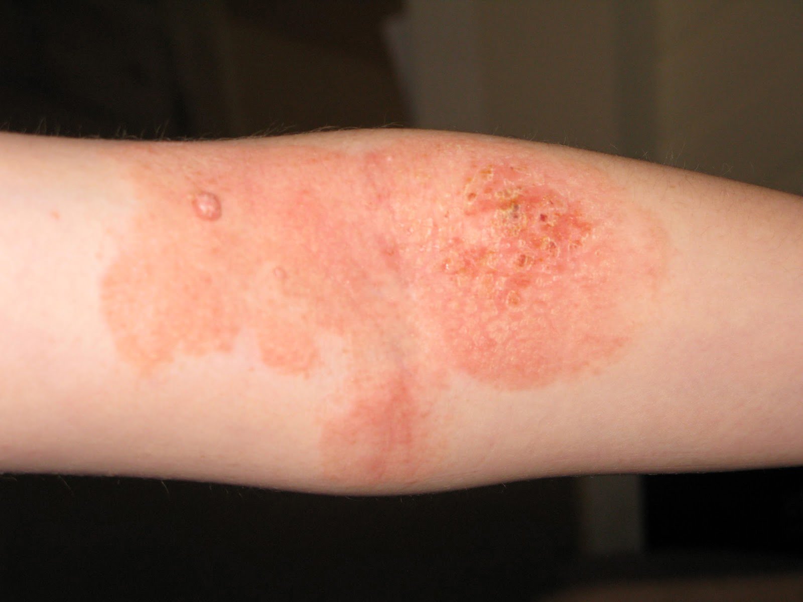 Các bệnh dị ứng ngoài da: Nguyên nhân và dấu hiệu nhận biết