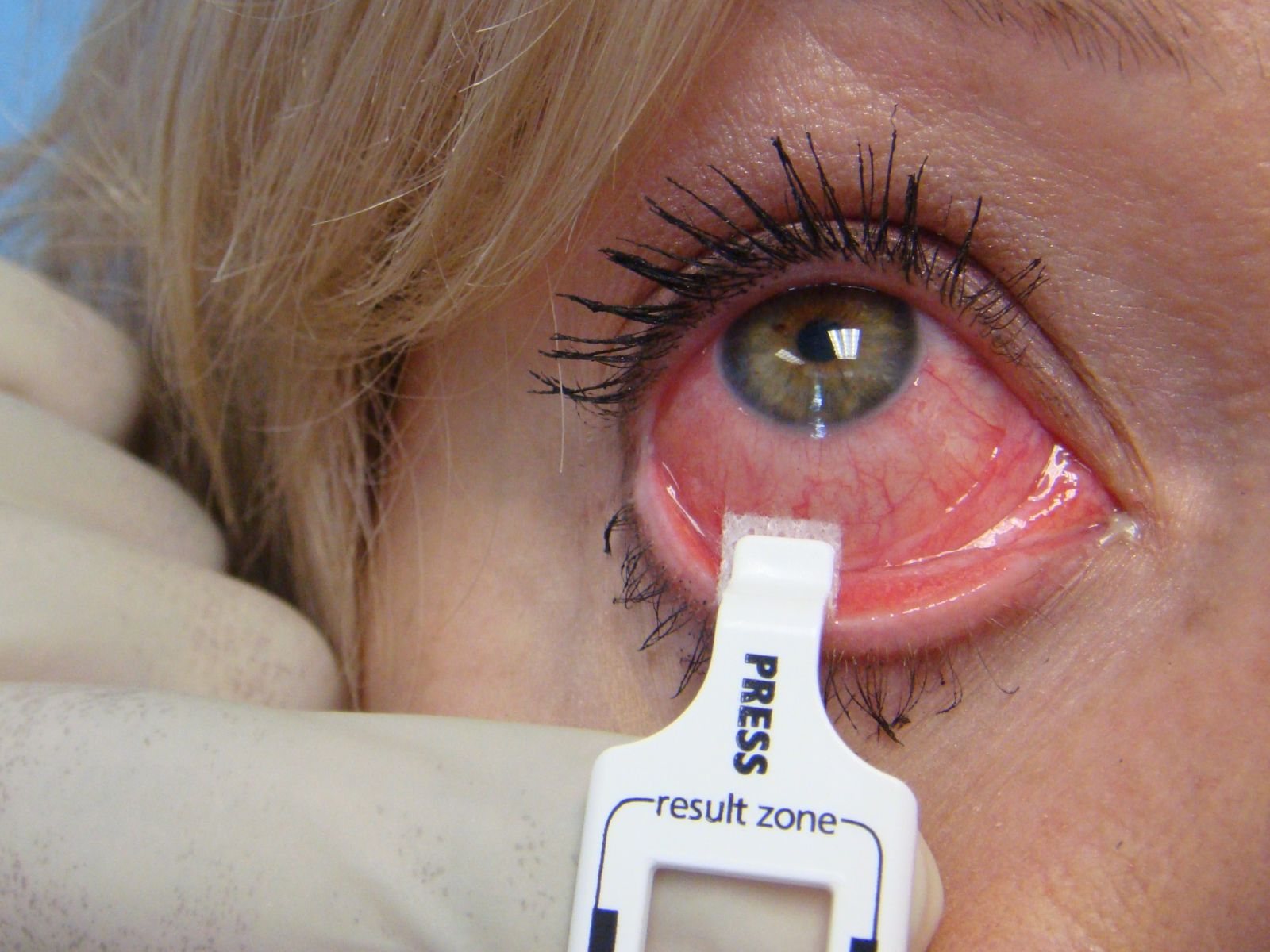 Cảm cúm mắt đỏ, triệu chứng nguy hiểm của bệnh cảm cúm 1