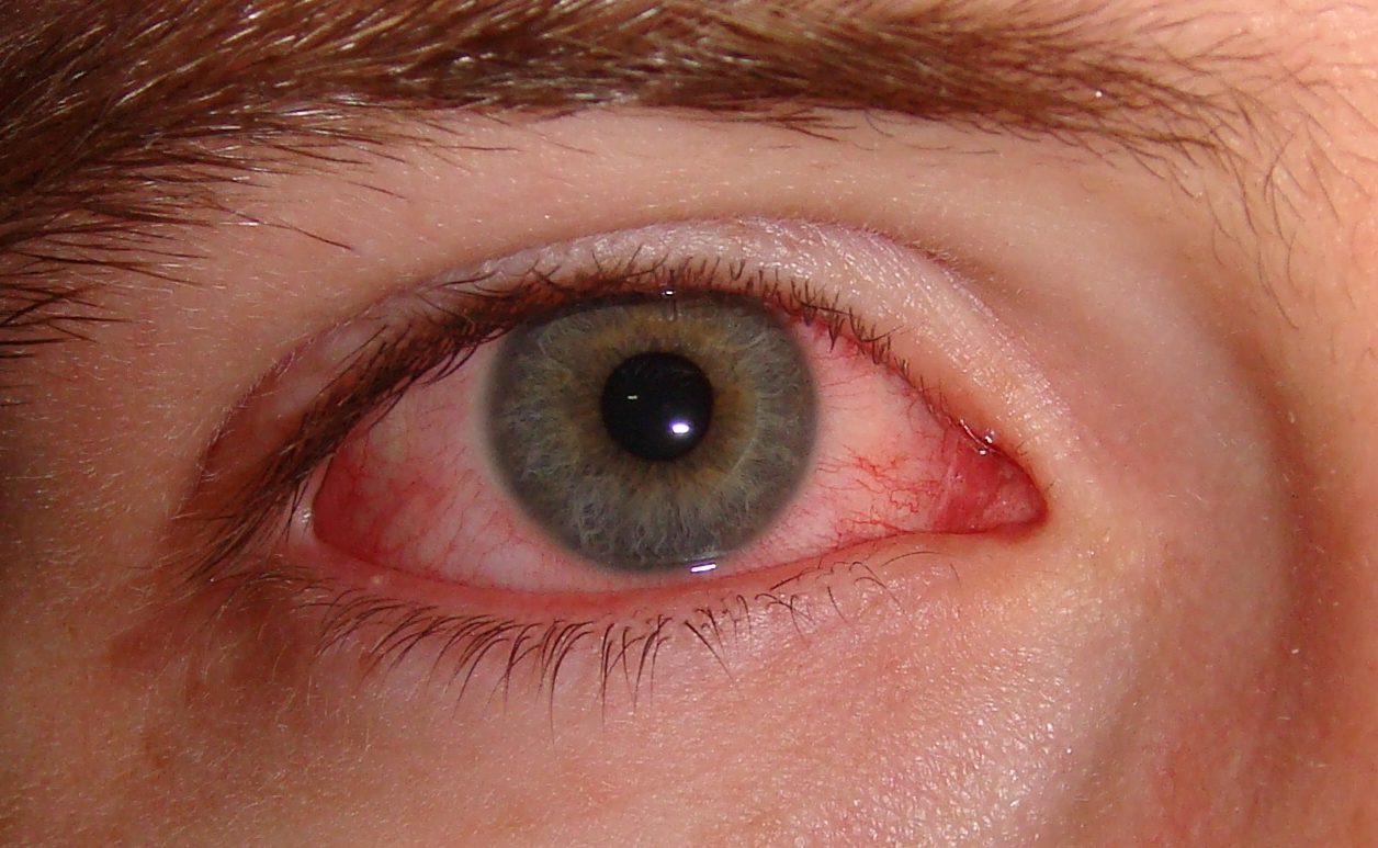 đau mắt đỏ dấu hiệu