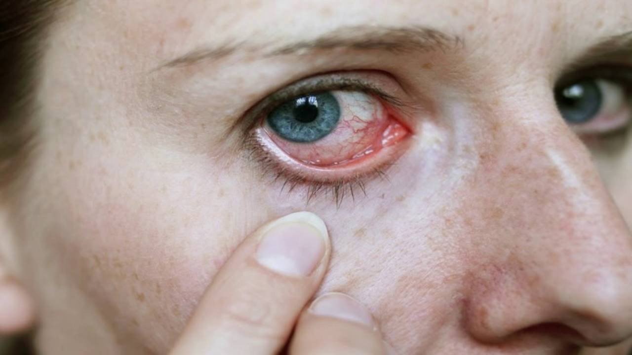 Dù có dịch hay không cũng cần phòng lây đau mắt đỏ 1