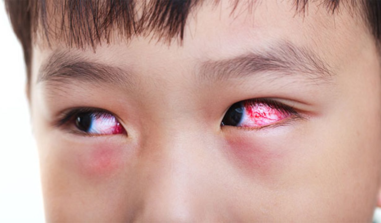 Hội chứng khô mắt và viêm kết mạc dị ứng 1