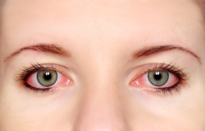 Khỏi đau mắt đỏ có bị lại không và phương pháp giúp hạn chế tình trạng bệnh tái phát nhiều lần? 1