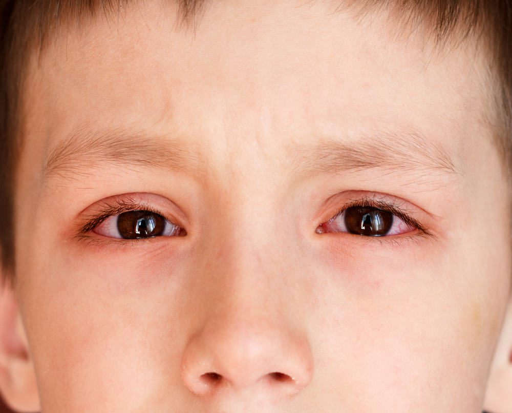 Kiêng khi đau mắt đỏ thế nào để bệnh nhanh khỏi? 1