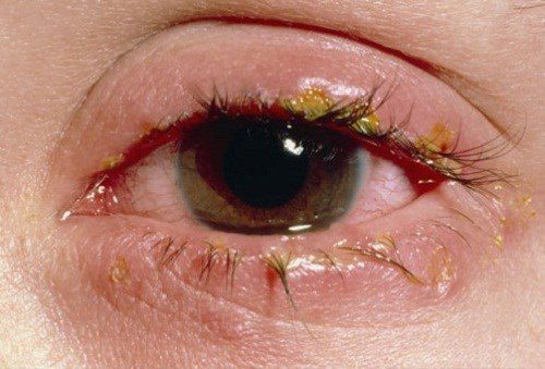 Làm sao để đau mắt đỏ nhanh khỏi cũng như phương pháp phòng tránh bệnh lây lan thành dịch? 1