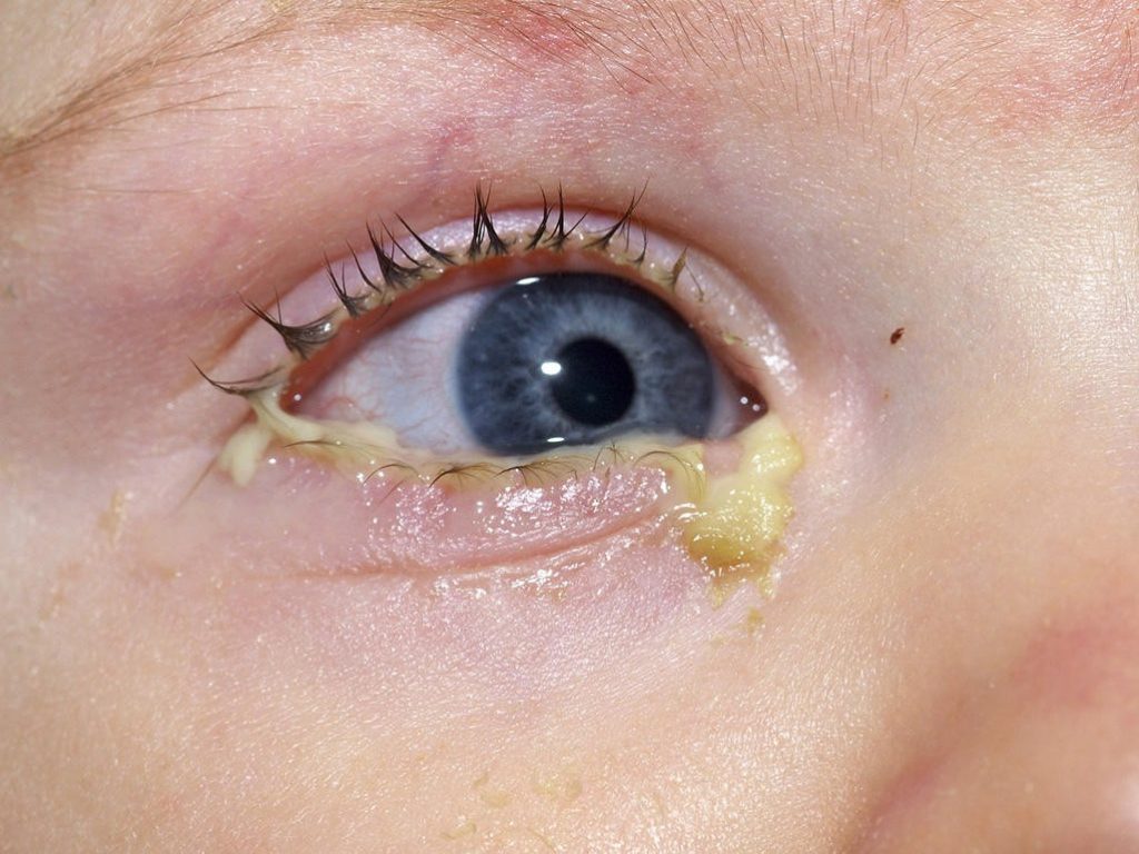 Mắt trẻ sơ sinh bị ghèn có sao không? 1