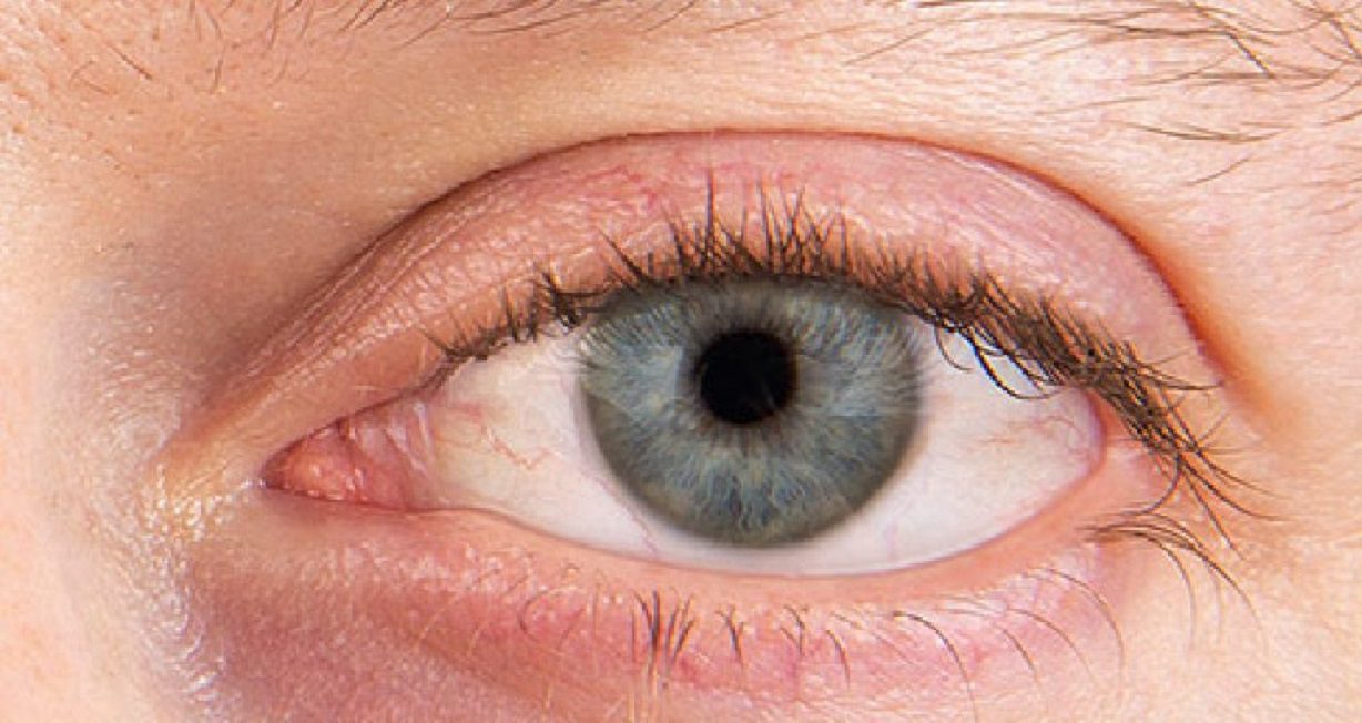 Nguyên nhân bệnh khô mắt và cách phòng ngừa1