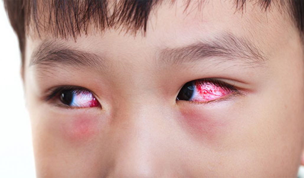 Nguyên nhân đau mắt đỏ và những triệu chứng thường gặp 1