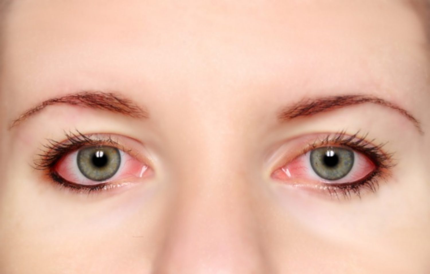 Tại sao lại có tình trạng đau mắt đỏ bị mờ mắt và cách điều trị ra sao 1