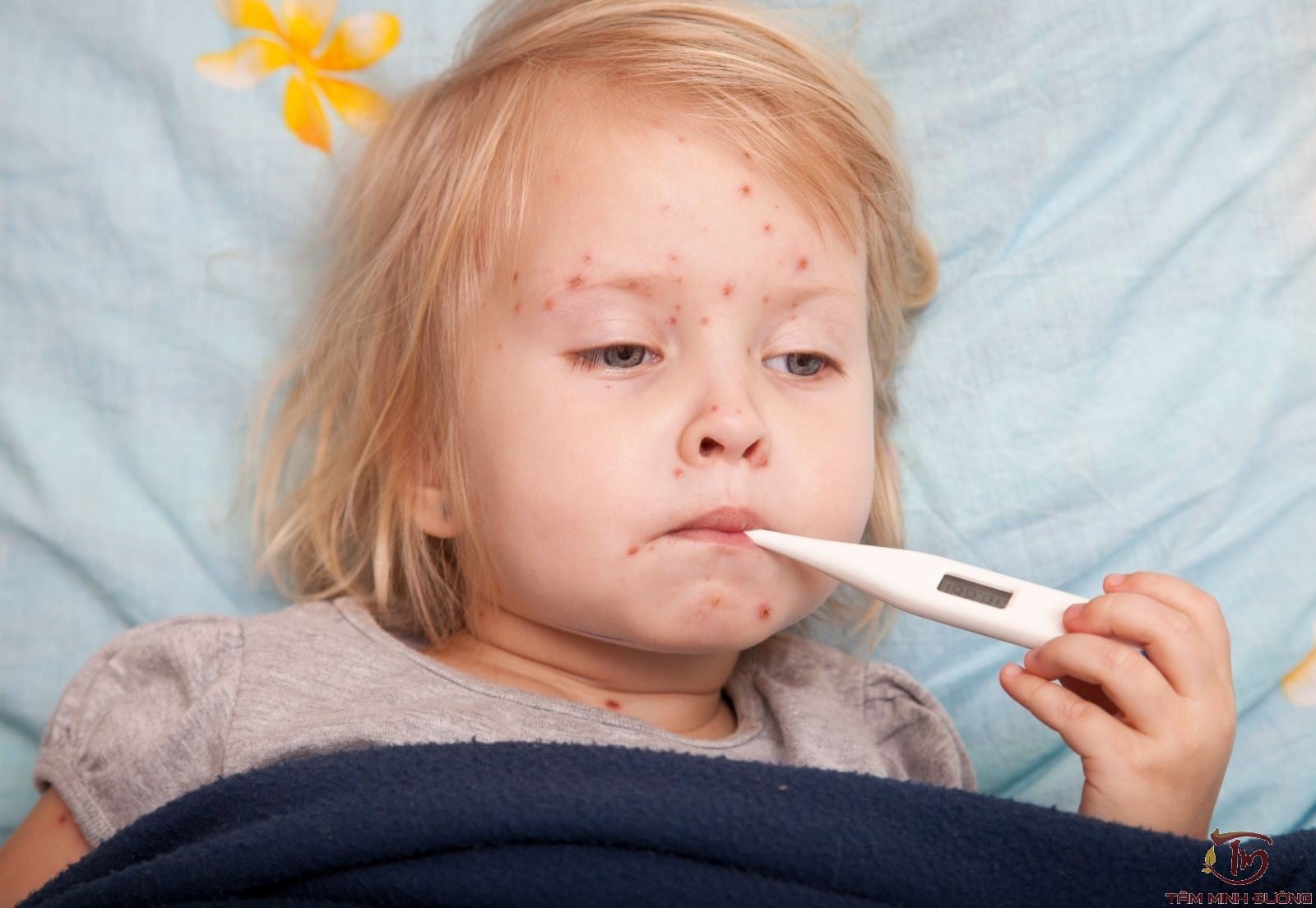 Triệu chứng bệnh thủy đậu ở trẻ em1