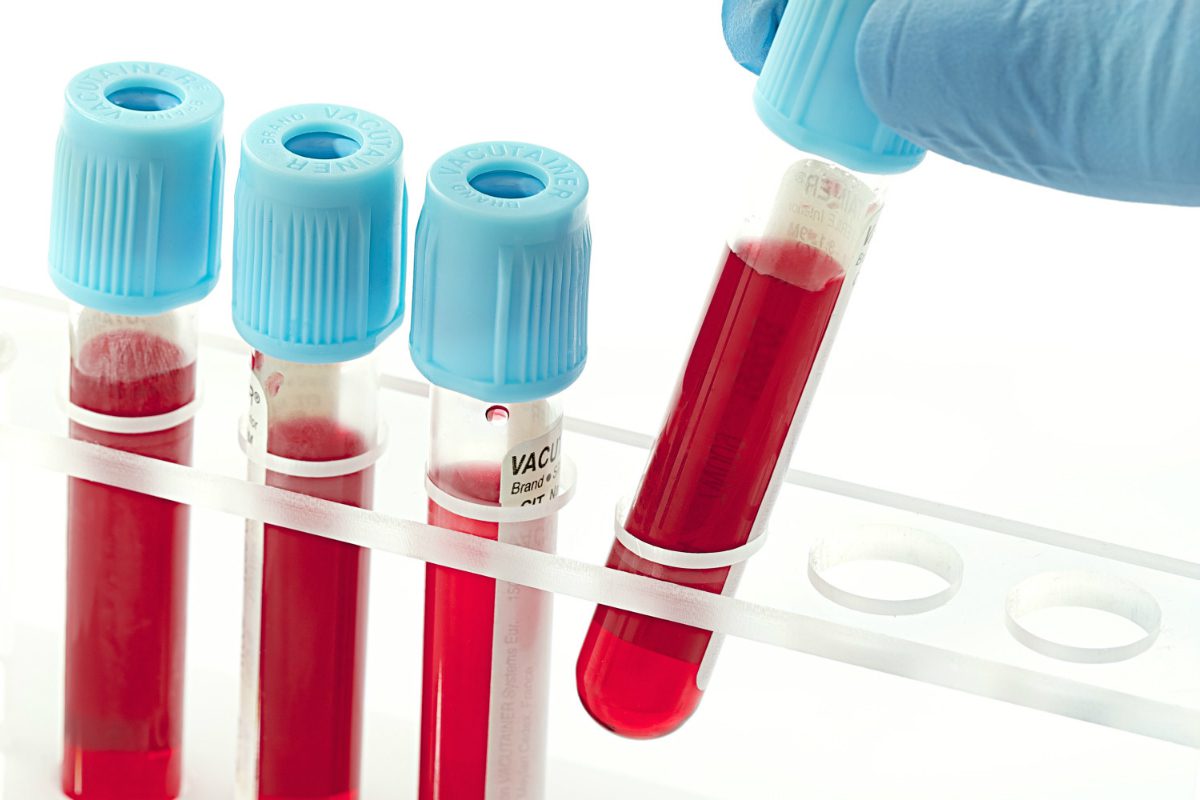 Xét nghiệm máu sởi có chẩn đoán được chính xác bệnh sởi không? 1