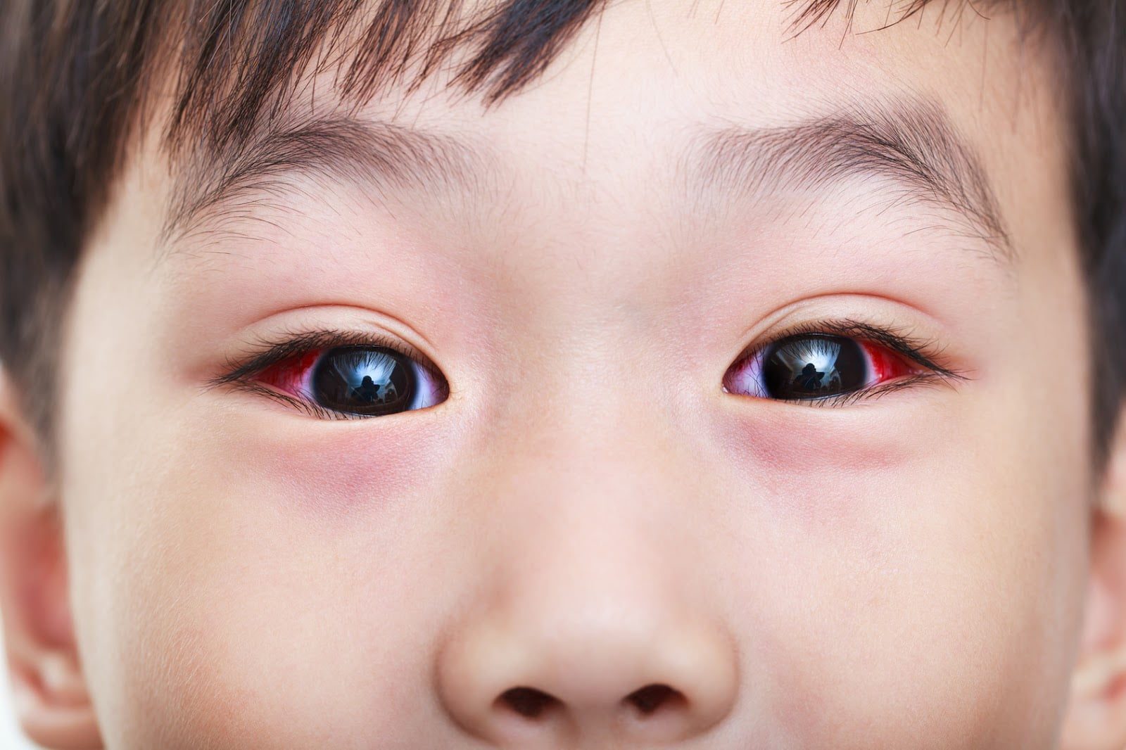 Đau mắt đỏ ủ bệnh bao lâu? 2