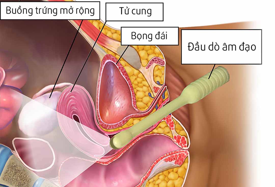 Góc giải đáp: Thai chưa vào tử cung siêu âm đầu dò có thấy không? 1