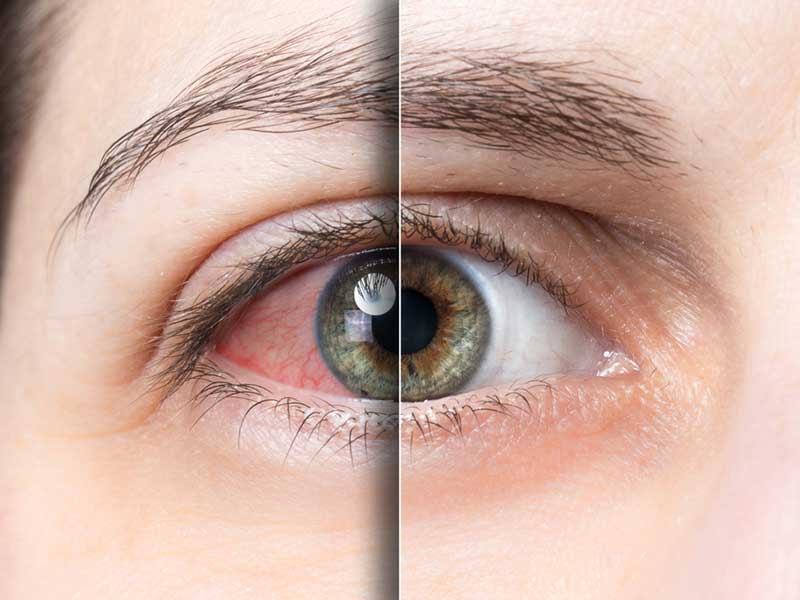 Những điều bạn cần biết về bệnh khô mắt mãn tính 1