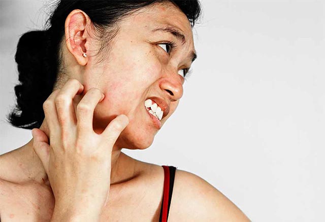 Tại sao da mặt bị dị ứng hải sản - Nguyên nhân và cách chữa trị hiệu quả 2
