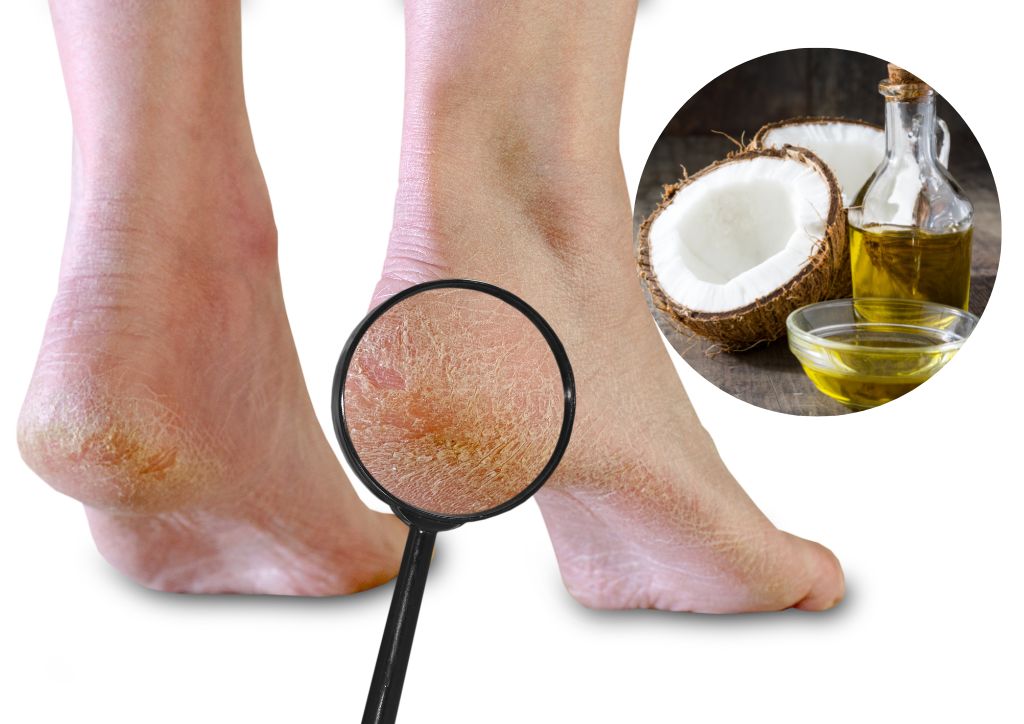 Top 7 cách trị da chân bị khô như da rắn từ những nguyên liệu sẵn có  4