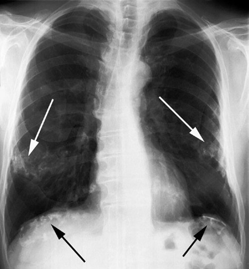 Xơ phổi: Triệu chứng, nguyên nhân và phương pháp điều trị bệnh 1