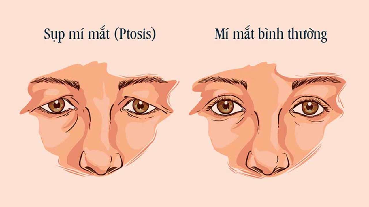 Các phương pháp phẫu thuật sụp mí mắt 1