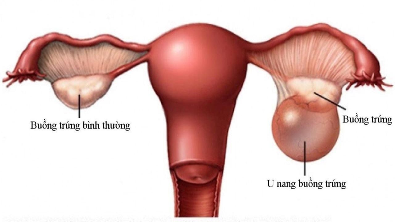 Phẫu thuật u nang buồng trứng và những điều cần biết 2