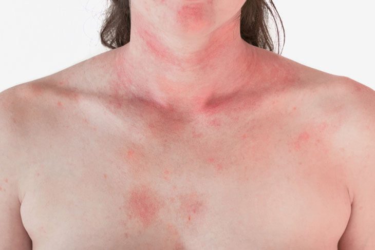 Dị ứng da do hậu covid là dấu hiệu thường gặp ở đa số người