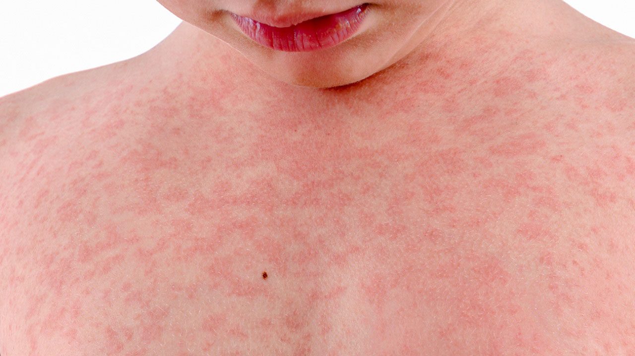 Tình trạng phát ban có thể làm cho da của trẻ trông loang lổ, đỏ, thô ráp và khô
