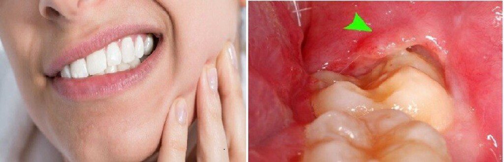 Nguyên nhân và cách điều trị sưng nướu răng trong cùng hàm dưới 1