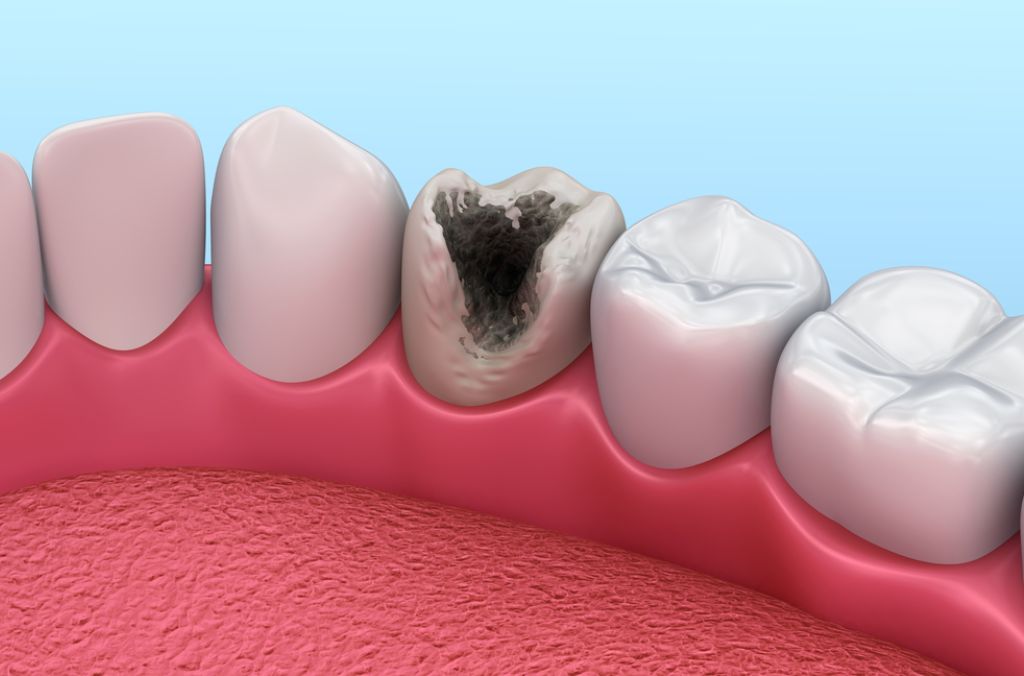 Bật mí cách chữa sâu răng hàm tại nhà đơn giản và hiệu quả nhất 1