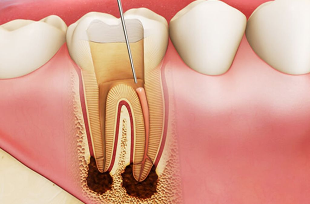 Chữa tủy răng bao lâu sẽ lành? Trường hợp nào thì cần chữa tủy răng? 1