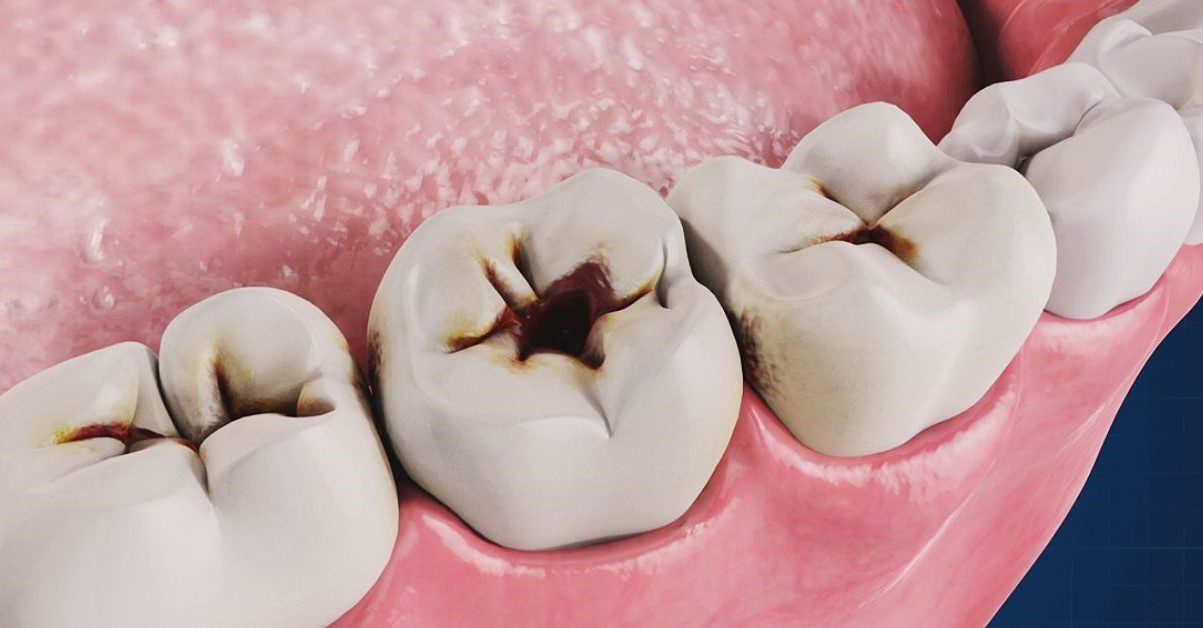 Có nên nhổ răng hàm bị sâu? Những điều cần lưu ý sau khi nhổ răng hàm 1