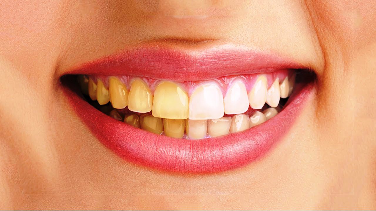 Keo dán răng sứ là gì? Những loại răng sứ đang được ưa chuộng1