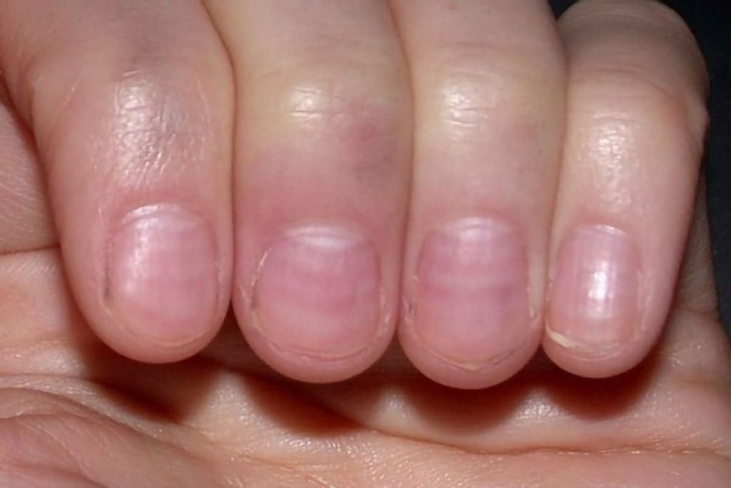 Móng tay bị sọc ngang là dấu hiệu của bệnh gì? Các tình trạng sọc khác ở móng tay?